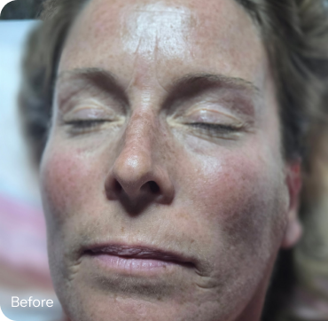 Close-up of clear skin texture around the nose and cheeks, showing the fine pore detail people mistake for blackheads in Fort Myers