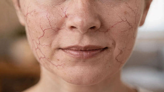 Broken Capillaries on Face: Causes, Care, and Treatments